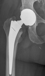 Prothèse totale de hanche droite
