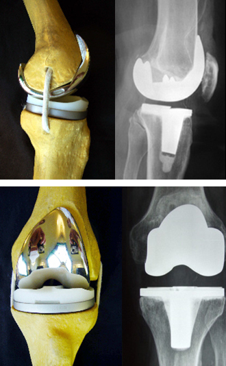 Genou – Ortho GHP